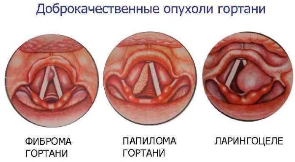 Zwelling in de keel. Symptomen, psychosomatiek, met welke arts contact, behandeling