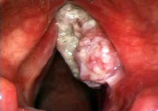 Zwelling in de keel. Symptomen, psychosomatiek, met welke arts contact, behandeling