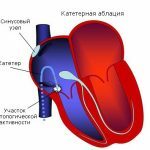 Radiofrequency ablation of the heart