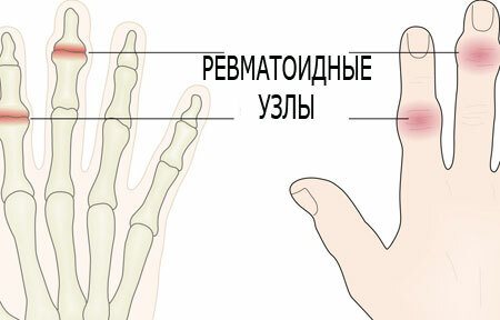 Behandlung der rheumatoiden Arthritis der Hände