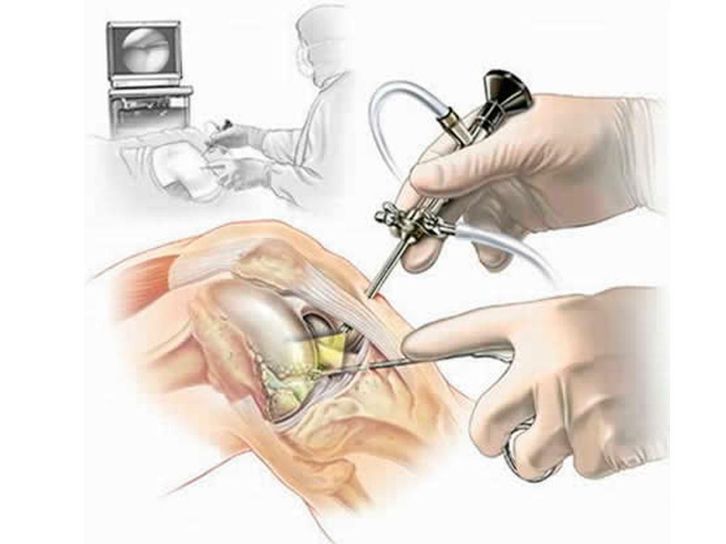 Cirurgia artroscópica