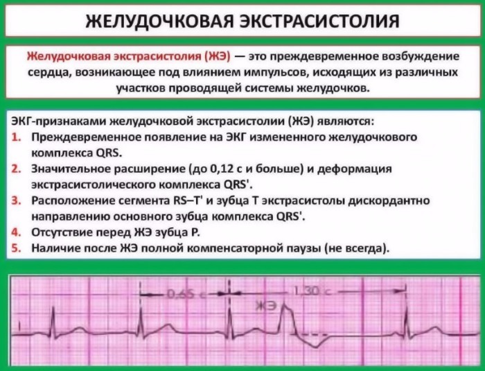Extrasístole ventricular en un ECG: signos de lo que es, decodificación