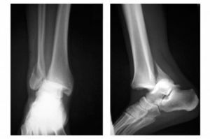Metode rehabilitasi dan perawatan setelah patah tulang pergelangan kaki dengan perpindahan dan tanpa