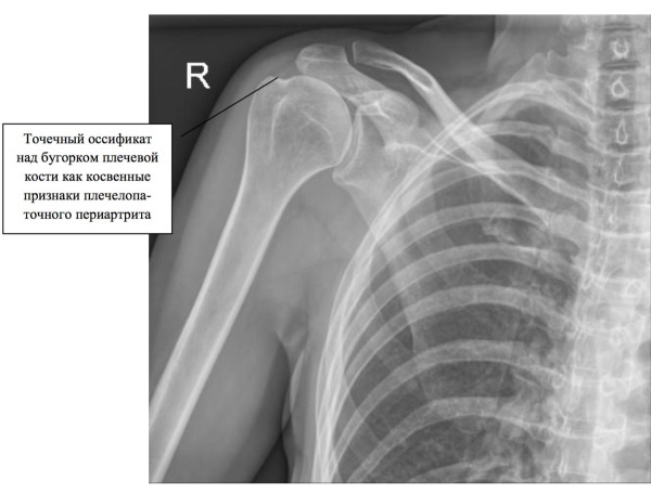 Shoulder-scapular periarthritis. Drug treatment, exercise therapy, drugs