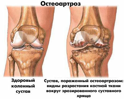 Osteoarthritis des Kniegelenks - Behandlung, Symptome, übungen, lfq, Massage, Folkbehandlung und Salben