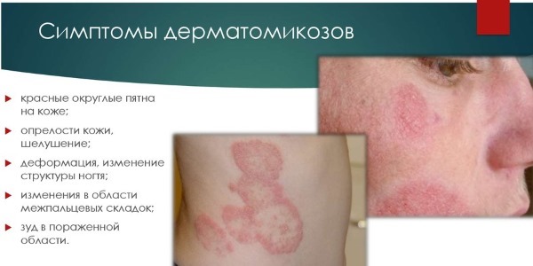 Ringworm. Symptoms and Treatment. What is it, pathogens, disease diagnosis, ointment for skin