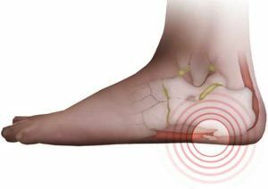 Plantar fasciitis is easier to prevent than cure