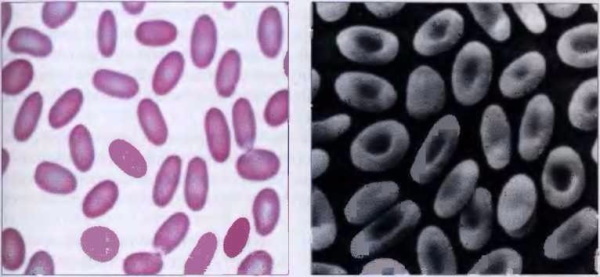 MCHC într-un test de sânge este crescut la un copil. Cauze
