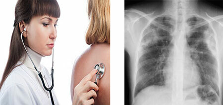 Tratamento de pneumonia: antibióticos, hospitalares, sinais em um adulto