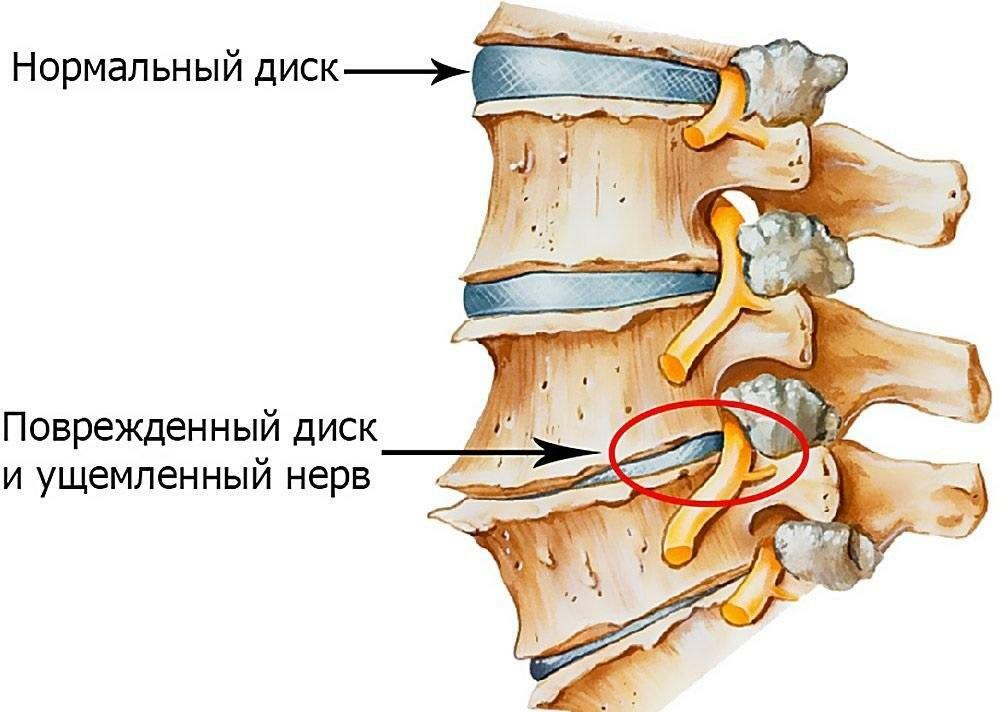 Intervertebral disk med osteochondrose af lumbosakral rygsøjlen