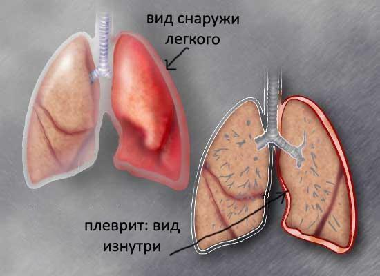 keuhkopussintulehdus