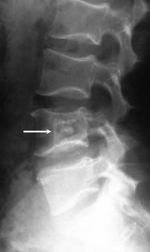 Osteoma of the vertebra
