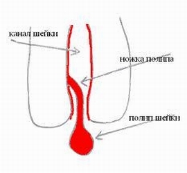 Polype du canal cervical: photo