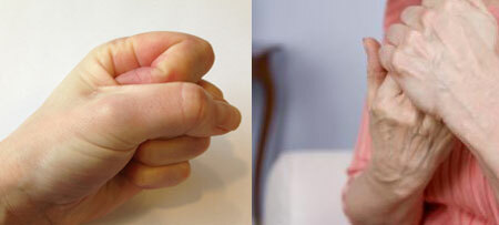 The first symptoms of rheumatoid arthritis of the fingers