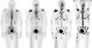 Röntgenfoto in metastasen
