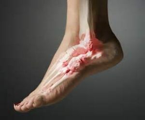 Inflammation of the tendon of the foot