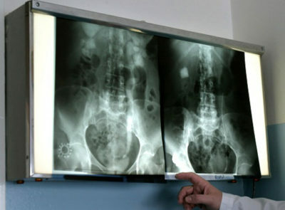 Röntgenfoto van de maag( twaalfvingerige darm): wat is het?