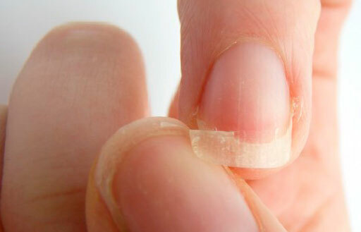 Nagel schimmel op handen: foto, behandeling, eerste fase