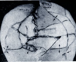 fractură fragmentată a craniului