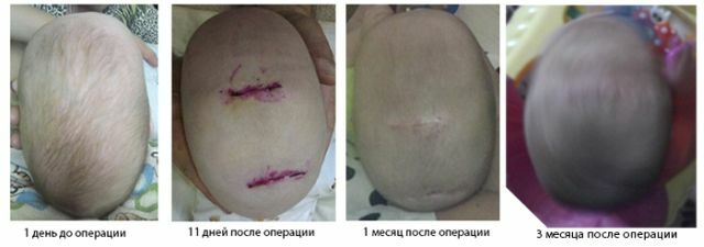 před a po operaci pro korekci lebky