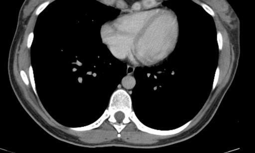 Spontaneous rupture of the dermoid cyst with the development of lipoid pneumonia