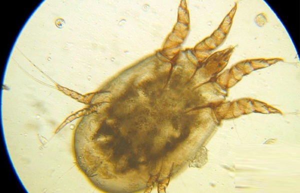 Scabies. Photo of a person, treatment at home: drugs, folk remedies, sulfuric ointment, tar soap, apple cider vinegar. Incubation period