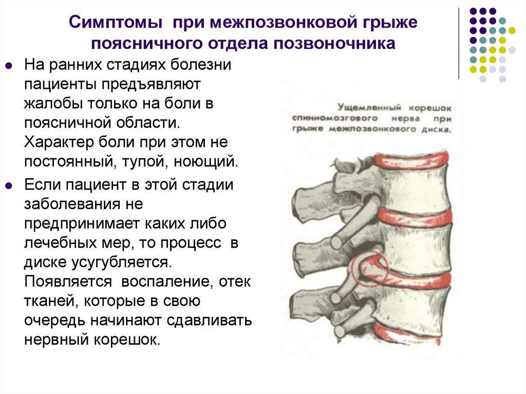 Sinais de hérnia de coluna vertebral da região lombar - informações detalhadas