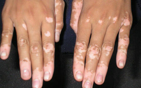Vitiligo foto 2. simptomi