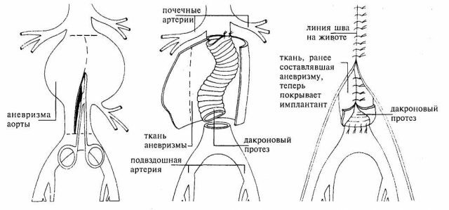 Wewnątrz przerywana proteza aorty