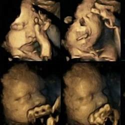 Ultralydbilder viser hvordan et barn i livmoren reagerer på en mors røyking