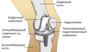 penggantian lutut
