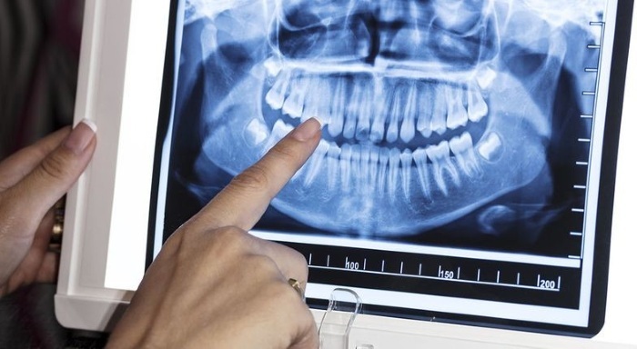 Radiografía de dientes. Toma panorámica, cómo lo hacen, qué muestra