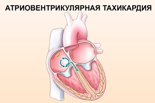 Sirds tahikardija. Cēloņi, simptomi un ārstēšana