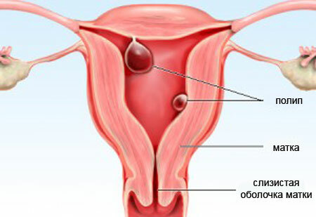 Polyps in the uterus: causes, symptoms and methods of treatment