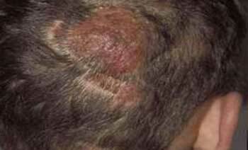 Microsporia del cuero cabelludo