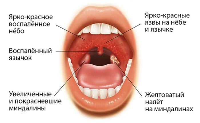 Symptome von Angina pectoris