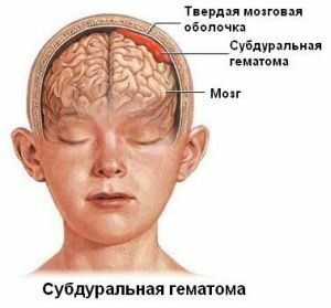 subdural hematoma of the brain