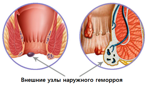 external nodes of external hemorrhoids