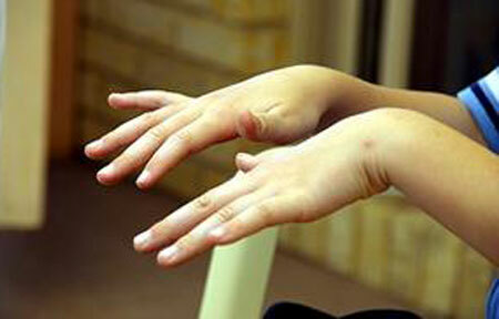 Treatment of hand tremor, drugs