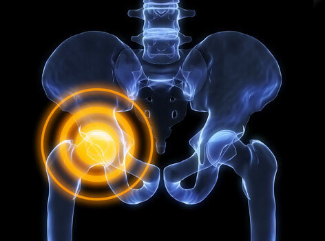 Artrosis deformante de la articulación de la cadera