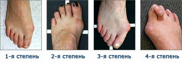 degree of deformation of the foot