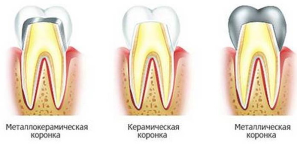 Tooth crowns. Types, which are better, pros, cons, prices