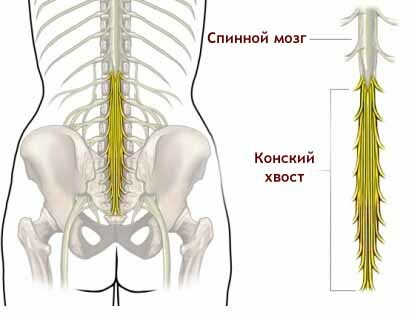 Sarcoma espinal. Síntomas y manifestación, pronóstico.