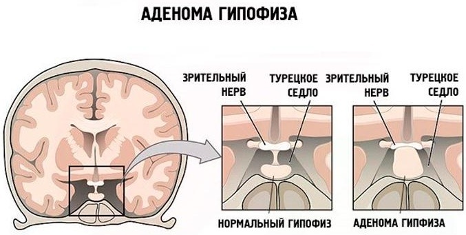 Tumor i hypofysen. Symptomer hos kvinder, mænd, børn, årsager, behandling