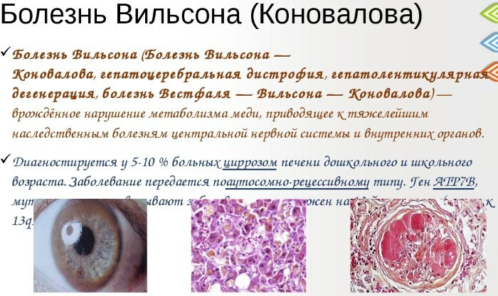 Enfermedad de Wilson-Konovalov. Tratamiento, diagnóstico, guías clínicas, patogenia.