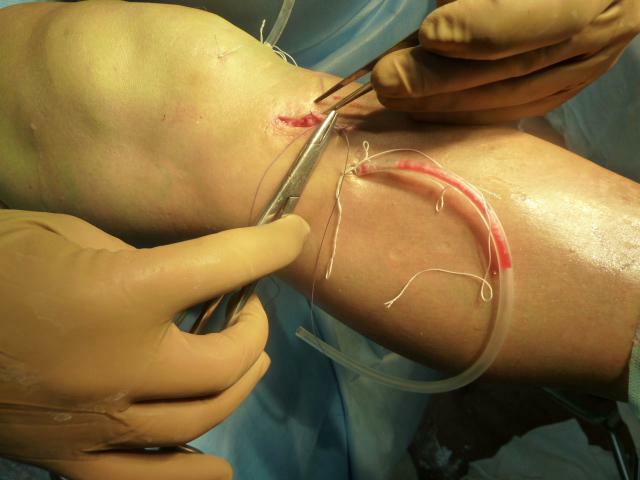 Artroscopía de la articulación de la rodilla