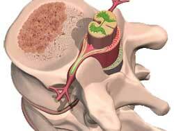 Symptomer på hemangiom i ryggvirvelens kropp