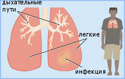Hvad er lungebetændelse?