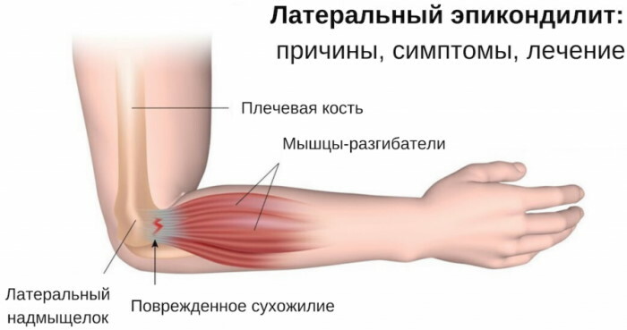 Il gomito fa male all'articolazione durante lo sforzo. Cause, trattamento
