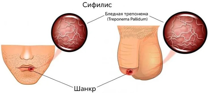 Treponema pallidum (tryponema blek) totala antikroppar. Vad är det, vad betyder det positiv, negativ analys, avkodning